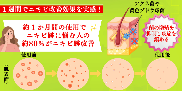 クリンダマイシンゲルの効果